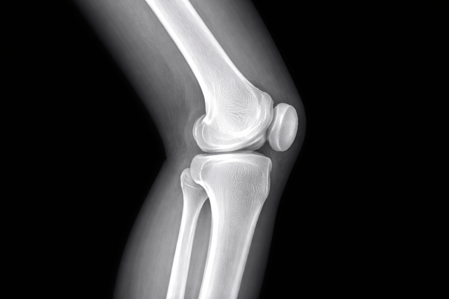 Radiografia de Rodilla